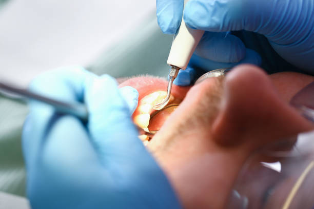 Best Chipped Tooth Repair Near Me  in South Bradenton, FL